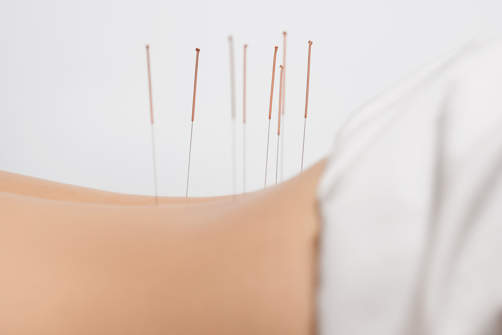 Acupuncture